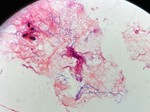 A case report on Nocardia